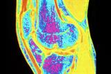 Prolotherapy may be used to treat osteoarthritis of the knee