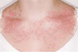 Urticaria: contact with an allergen can provoke sudden release of preformed inflammatory mediators (SPL)