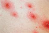 Chickenpox may complicate three in every 1,000 pregnancies (Photograph: SPL)