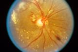 Hypertensive retinopathy: damage to the retina due to high BP