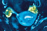 Polycystic ovaries: women with PCOS are more likely to develop MI (Photograph: SPL)