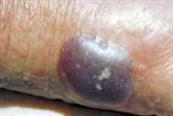 Over time the tense blisters can become purulent and haemorrhagic (Photograph: Author image)