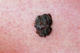 A malignant melanoma (Photograph: SPL)