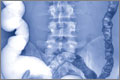 Distended colon due to constipation in IBS, seen on barium X-ray