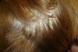 Scalp psoriasis can be mistaken for seborrhoeic dermatitis (dandruff) (Photograph: Dr Anshoo Sahota)