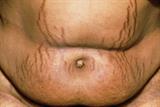 Stretch marks caused by Cushing's syndrome (Photograph: SPL)