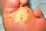 Infected ulcers (shown above) should be cultured for aerobic and anaerobic bacteria (Photograph: SPL)