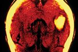 A systematic review found no association between statins and intracerebral haemorrhage (above) (Photograph: SPL)