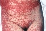 Stevens-Johnson syndrome is usually drug-related