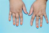 Lymphoedema of the hand in an adult female patient following surgery for breast cancer (Photograph: SPL)