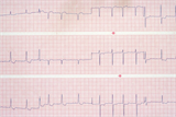 Electrocardiogram (EKG) depicting atrial fibrillation