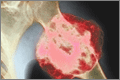 A benign bone-containing tumour in the proximal humerus (CNRI / SPL)