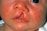 Five-week-old baby with a cleft lip. Surgery for cleft lip is usually carried out at three months of age (Photograph: SPL) 