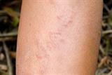 Eosinophilia may be marked in cutaneous larva migrans infestations (Photograph: SPL)