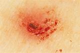 After a tick bite, an asymptomatic or slightly itchy erythematous rash appears