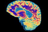 Brain scan depicting MS: oral treatment could have a 'major impact'