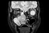 Juvenile nasal angiofibroma may cause severe nasal bleeding associated with nasal obstruction (Photograph: SPL)