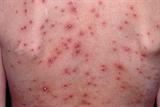 Varicella: red papules emerge