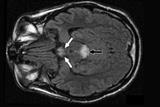 Axial FLAIR images show abnormal high signal intensity in the  mammillary bodies (white arrows), periaqueductal area (black arrow) (Author Images)