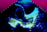 In unexplained recurrent miscarriage, there is a good prognosis for a future pregnancy