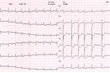 ECG showing AF: A quality of life is not dependent on absolute heart rate, research has shown