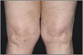 Severely swollen knees: knee replacement surgery may be necessary