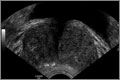 Transrectal ultrasound can accurately measure prostate volume