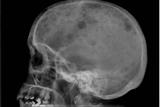 Characteristic osteolytic lesions in the skull of a patient with myeloma (Photograph: Author images)