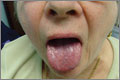 Dry mouth, or xerostomia, is more common in elderly patients