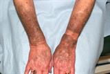 Marked blue/grey discoloration of light-exposed areas of forearms