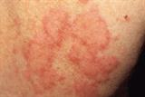 Urticaria presents as weals with erythema (Photograph: SPL)