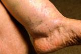 Ankle swelling oedema may be present with hyponatraemia