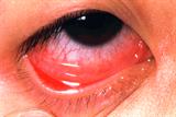 Hayfever is associated with conjunctivitis 