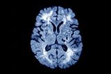 MRI of patient with CADASIL, which is a hereditary cerebrovascular disorder (Photograph: SPL)