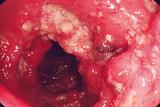 Severe CD: 'cobblestone' appearance seen on endoscopy