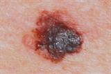 Irregularly pigmented mole on the back: excision biopsy showed an MM with Breslow thickness of 0.7mm (Author image)