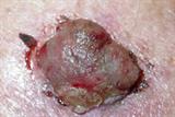 Nodular melanoma has rapid growth and appears inflamed