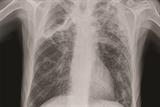 Chest X-ray showing widespread, ill-defined and nodular shadowing