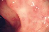 In early mild CD the mucosa may show multiple aphthoid ulcers only