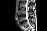 Prolapsed intervertebral disc is a common cause of sciatica (Photograph: SPL)