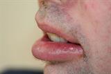 Chronic swelling of the lip