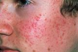 Acne vulgaris (Photograph: SPL)