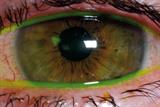 Corneal abrasion: consider referral to an opthalmologist if corneal damage is suspected (Photograph: SPL)