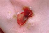 Antibiotics were shown to improve symptoms of otitis media in children (Photograph: SPL)