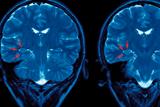 MRI scans showing abnormal and asymmetrical hippocampal regions in the brain of a patient with epilepsy (Photograph: SPL)