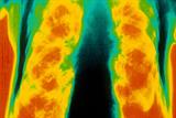 Combination therapy for COPD was thought to give additional benefits