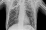 Chest X-ray showing widespread, ill-defined and nodular shadowing (Photograph: Dr Ian Campbell)