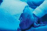 Neonatal jaundice can be treated with phototherapy (Photograph: SPL)