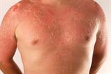 1.The most common presentation of sunburn will include burning, pain and erythema of the affected area of skin (Photograph: SPL)