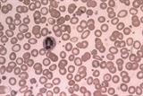 Hypochromic red blood cells may be seen in microcytic anaemia (Photograph: SPL)